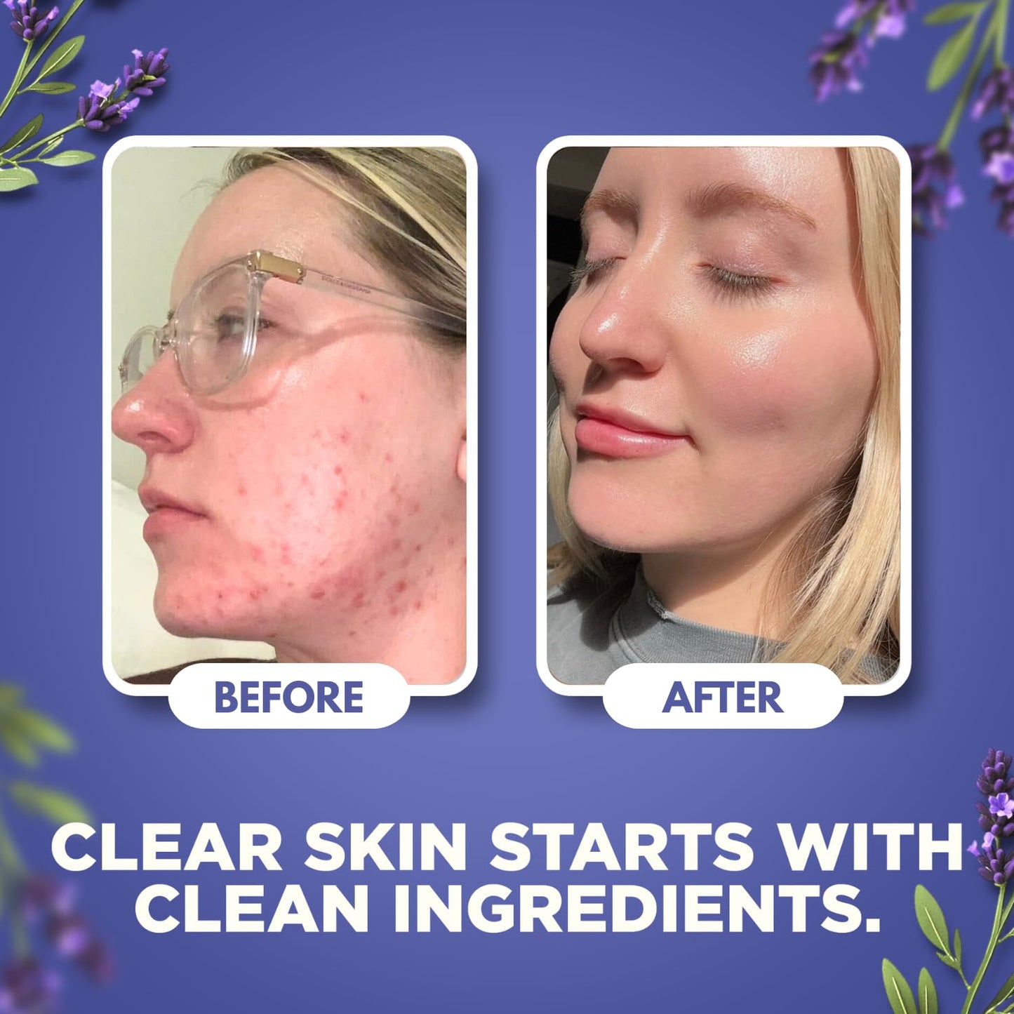 Whipped Beef Tallow for Skin - Face + Body Moisturizer, 100% Grass Fed Grass Finished Tallow and Honey Balm for Dry Skin - Natural Lotion - Free of Harsh Chemicals - 4oz, (Lavender)