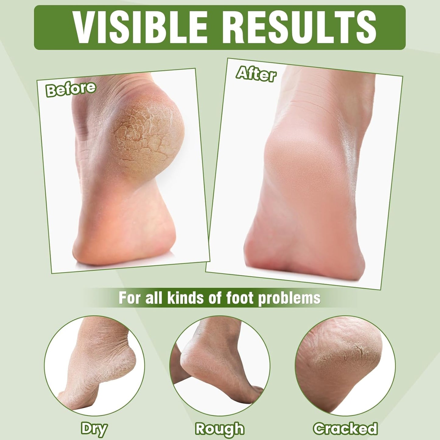 18 Pairs Moisturizing Foot Masks with Shea Butter, Jojoba Oil, Vitamin E & Urea, Intensely Hydrating Foot Mask For Dry Cracked Feet, Moisturizing Socks for Cracked Heel Treatment