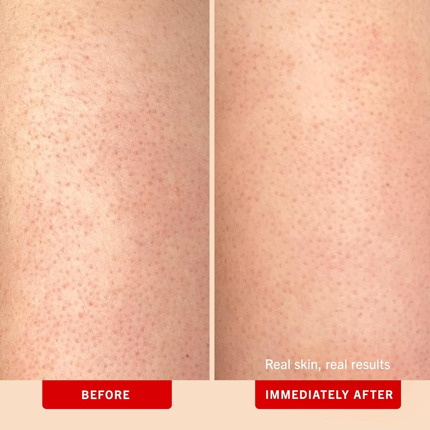 First Aid Beauty - KP Bump Eraser Body Scrub with 10% AHA, Keratosis Pilaris Exfoliator with Glycolic and Lactic acids, Helps Reduce Chicken Skin Bumps, Safe for Sensitive Skin, Peach Scent (8 oz)