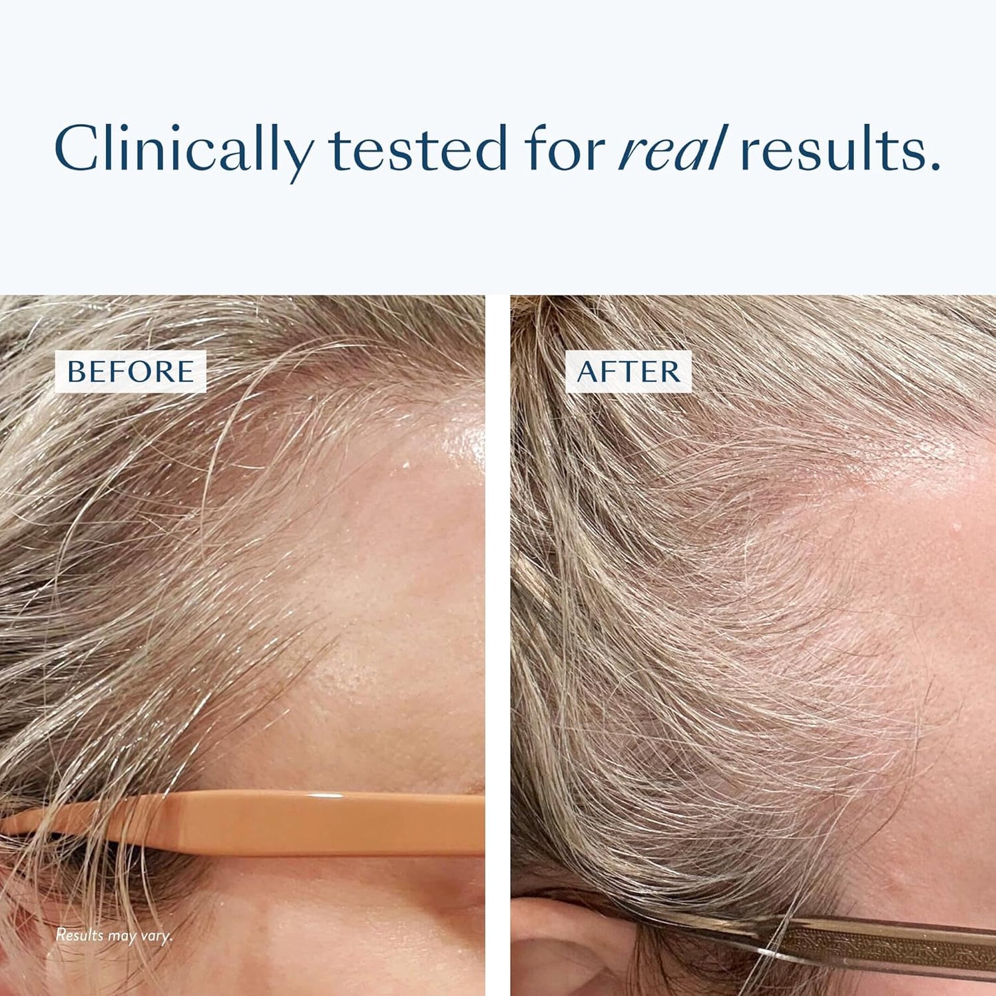 eSalon Hair Regrowth Treatment, 2% Minoxidil Topical Solution, 2.7 fl oz, One Month Supply, for Women