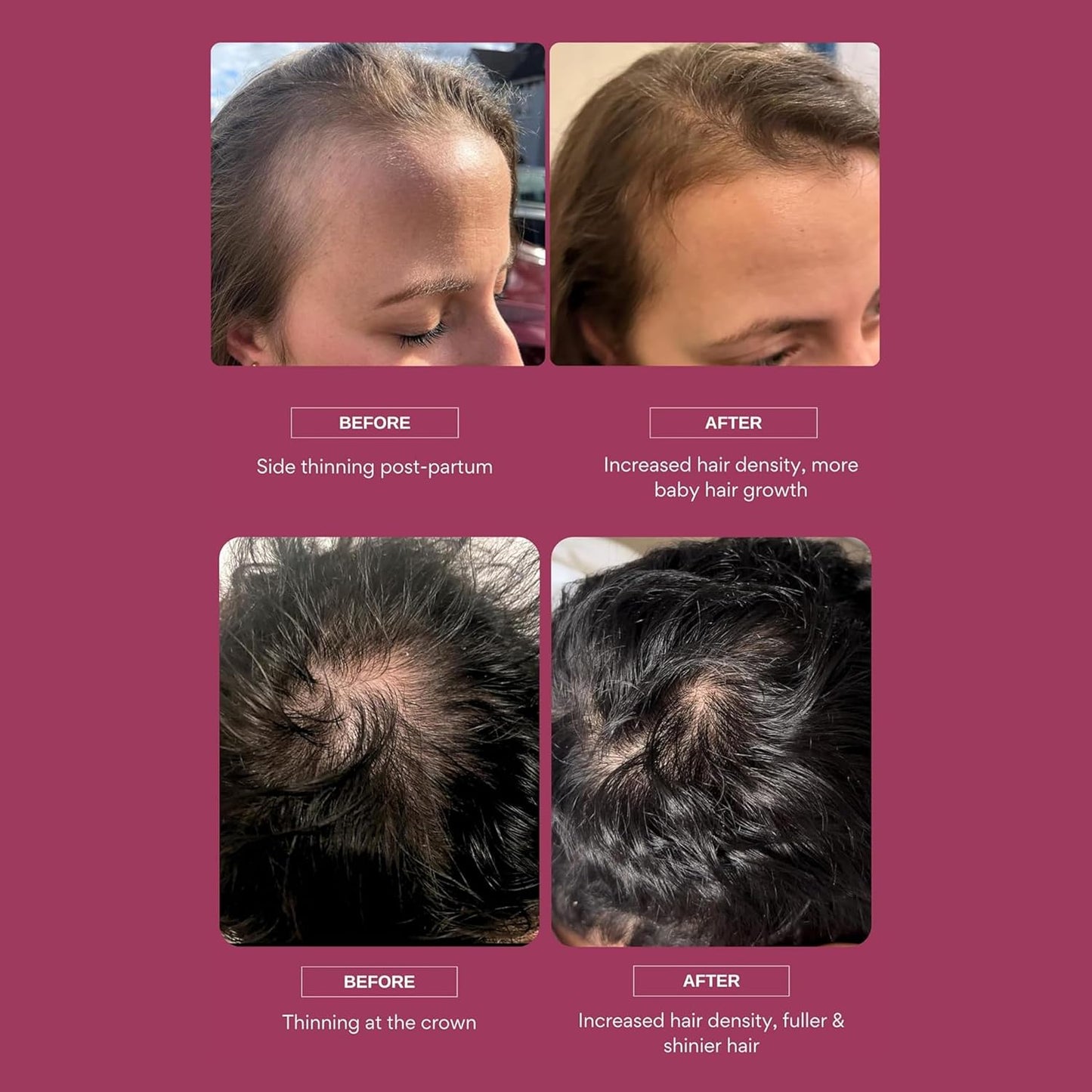 Hair Growth Serum with Caffeine, Probiotics, Aloe Vera | Promotes Hair Growth, Scalp Care, Thickness | Hair Loss Treatment for Women & Men, 50ml