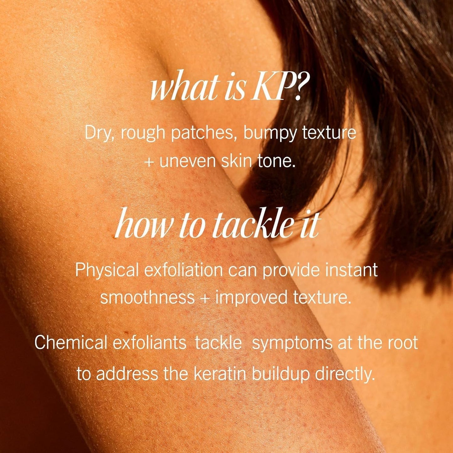 First Aid Beauty - KP Bump Eraser Body Scrub with 10% AHA, Keratosis Pilaris Exfoliator with Glycolic and Lactic acids, Helps Reduce Chicken Skin Bumps, Safe for Sensitive Skin, Strawberry Scent, 2 oz